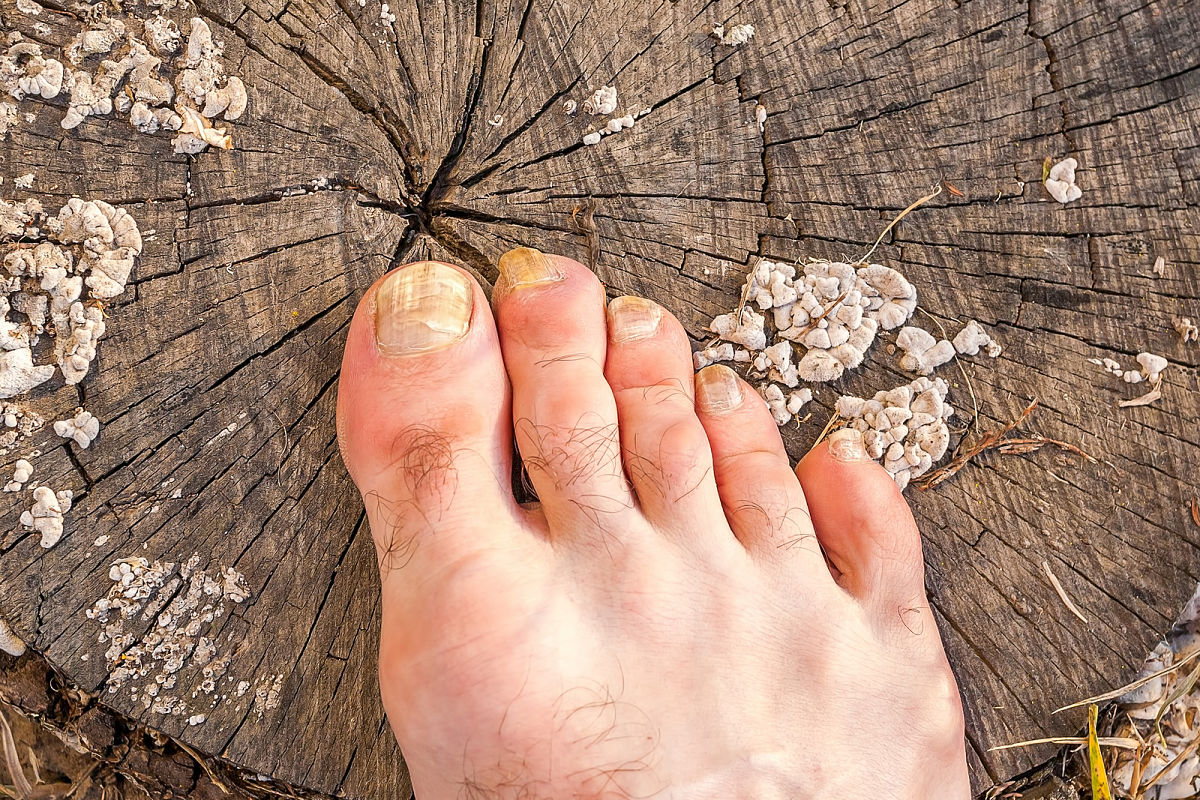 How to treat foot fungus at home