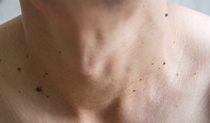 Cuello y pecho de hombre con verrugas pequeñas.