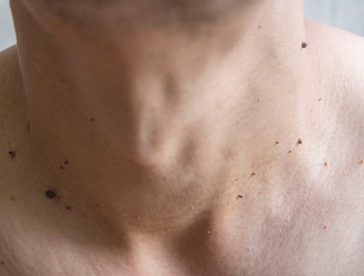 Cuello y pecho de hombre con verrugas pequeñas.