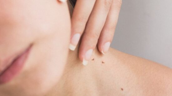 mujer joven con verrugas en el cuello