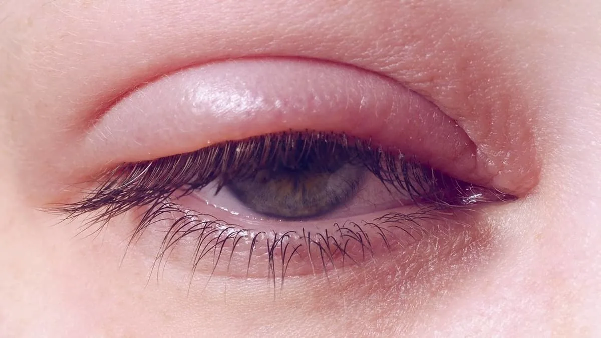 caspa en las pestañas