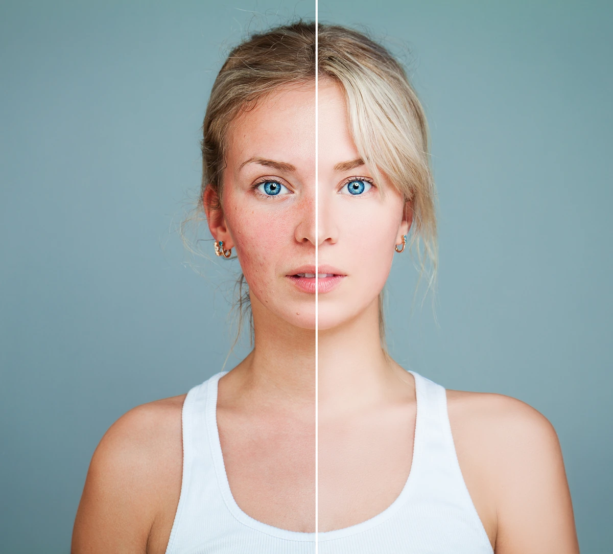 como curar la rosacea para siempre
