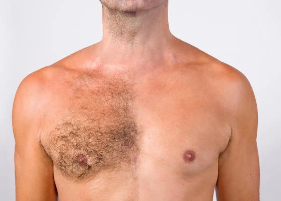 Comparativa del antes y después de la depilación masculina en el torso de un hombre, mostrando el resultado de eliminar el vello corporal.